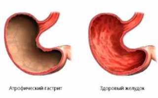 Атрофический очаговый гастрит