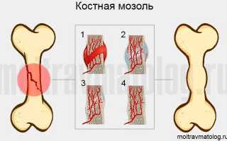 Что такое костная мозоль и как она выглядит после перелома