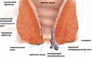 Что помогает при геморрое