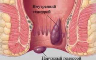 Что делать если возникли боли при геморрое