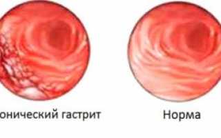 Смекта как средство от изжоги