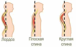 Лордоз, кифоз, сколиоз и другие искривления позвоночника