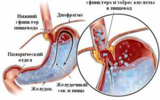 Что такое поверхностный гастродуоденит