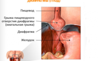 Эзофагит катаральный