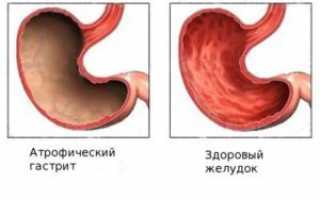 Диетическое питание при атрофическом гастрите