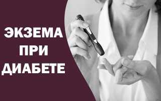 Влияние сахарного диабета на развитие экземы – особенности, стадии развития и причины