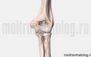 Перелом локтевого сустава: лечение и последствия