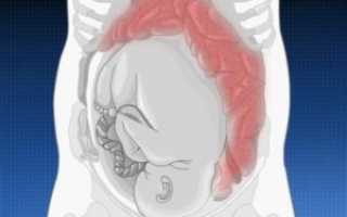 Запор у женщин после кесарева сечения