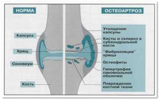 Артроз позвоночника (спондилоартроз): виды, симптомы и лечение