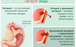 Зеленый чай: употребление при гастрите