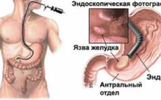 Гастрит катаральный