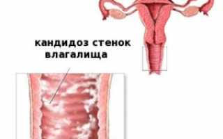 Какие бывают виды инфекционного заболевания — молочницы