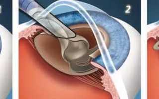 Что нельзя и что можно делать после операции по удалению катаракты