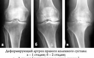 Как вылечить деформирующий артроз любой стадии