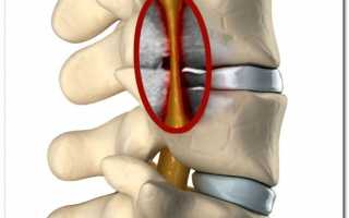 Симптомы и лечение стеноза позвоночного канала