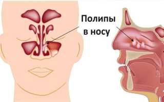 Компьютерная томография носовых пазух